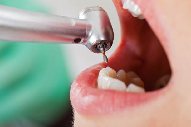 Best Emergency Dentist for Lost Fillings or Crowns in Mckee City, NJ